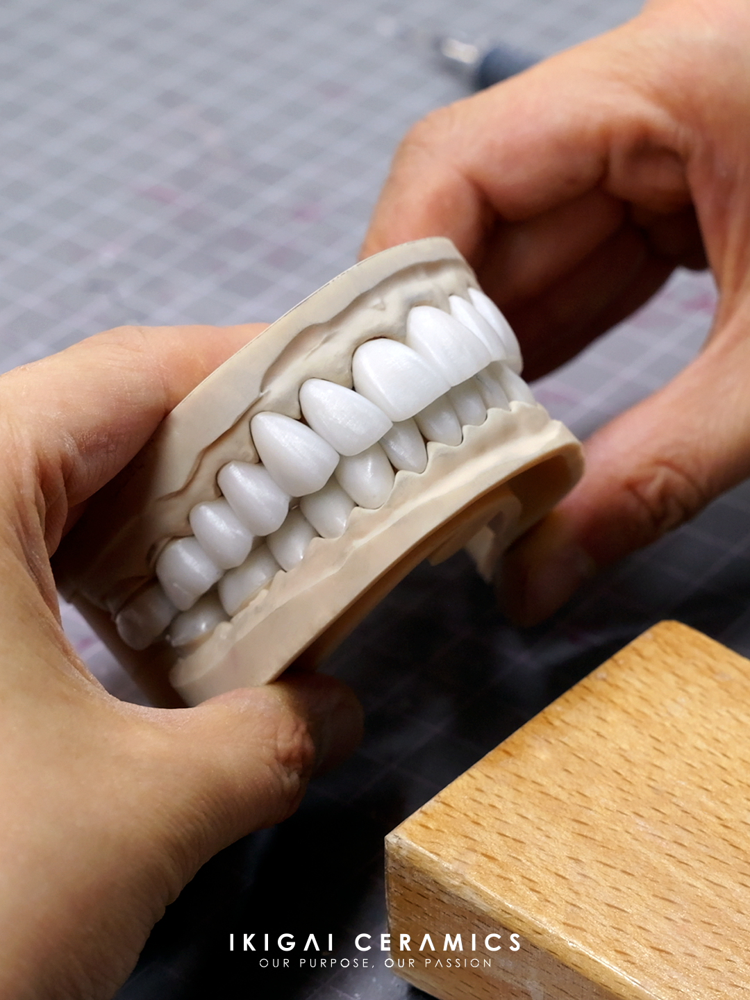 Smile Makeover — 10 Veneers