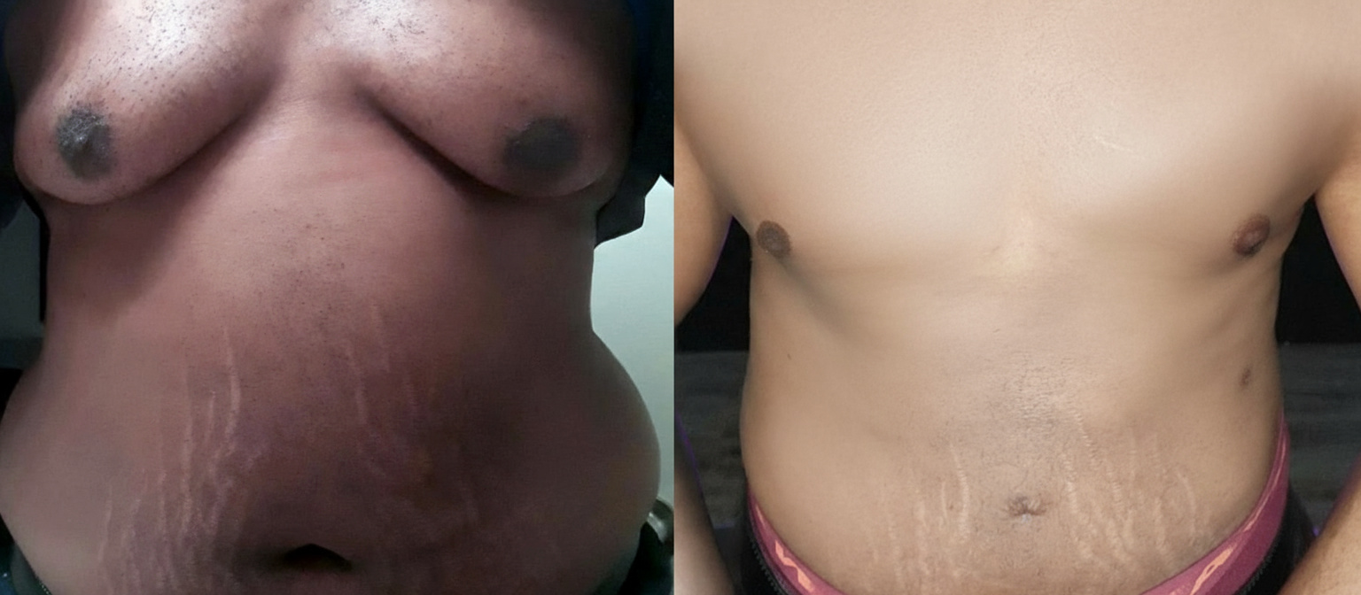 Male Breast Reduction before and after results