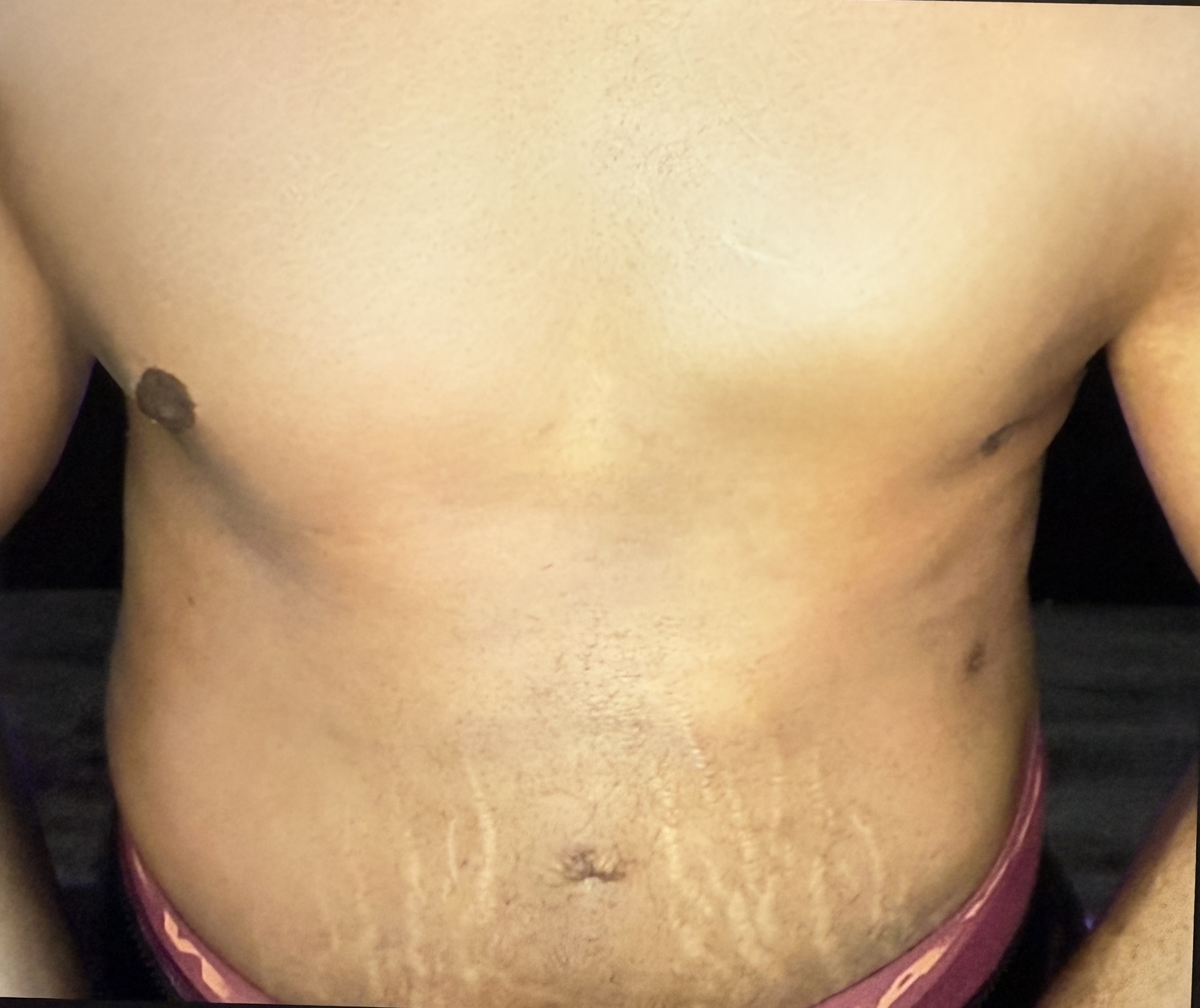 Male Body Contouring - After