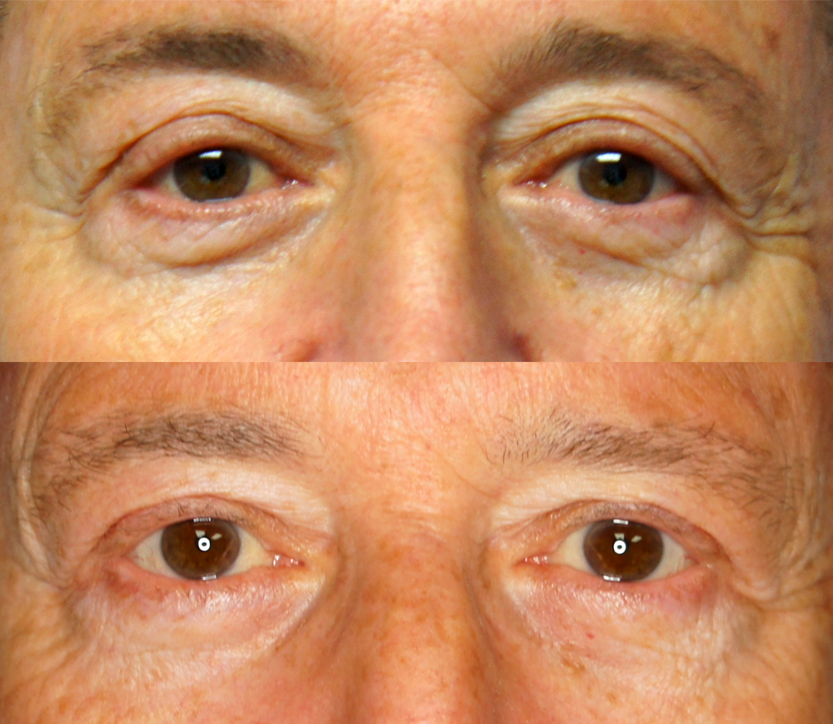 Blepharoplasty