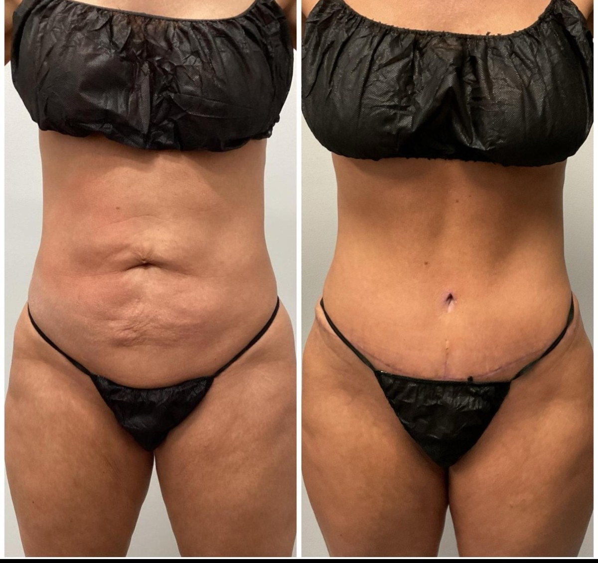 Abdominoplasty