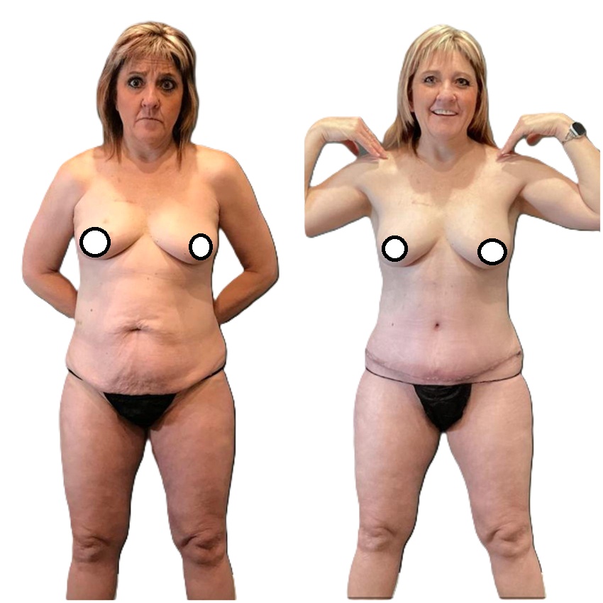 Abdominoplasty