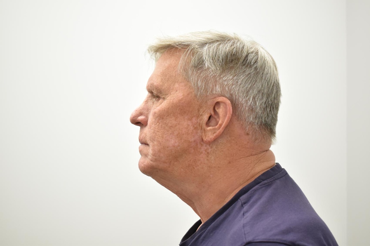 Lower Face & Neck Lift before