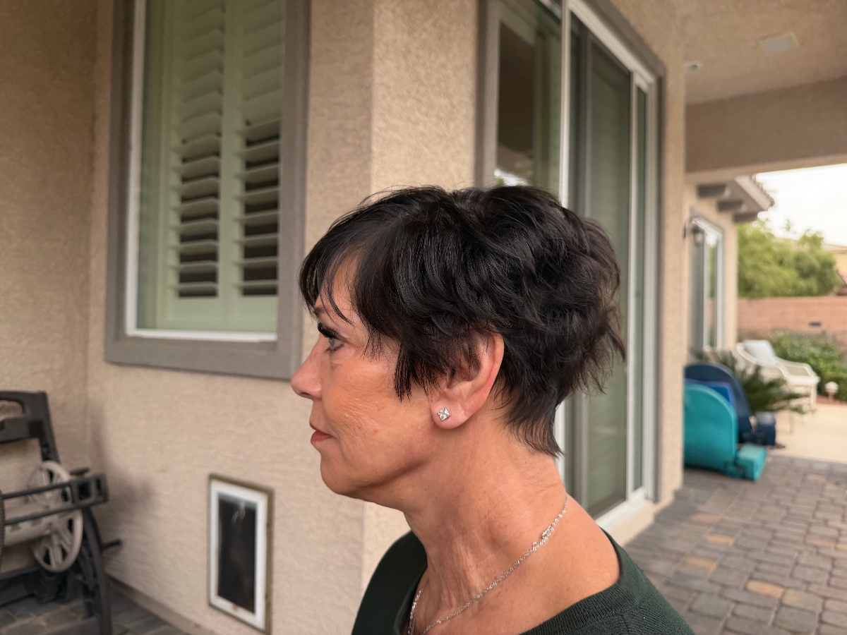 Lower Face & Neck Lift after