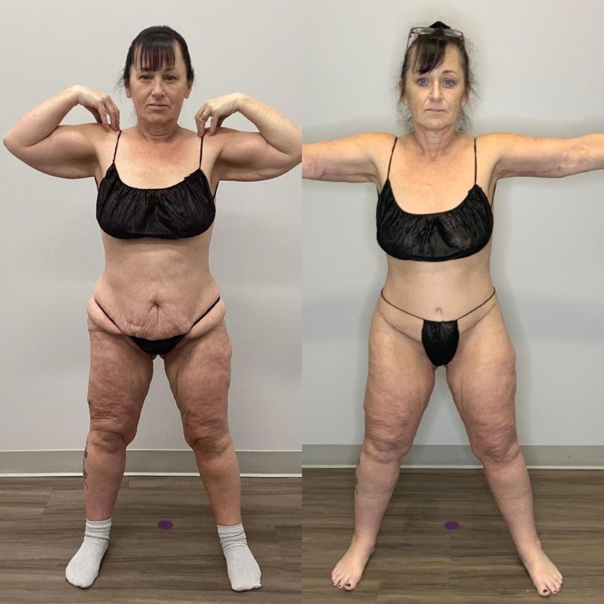 Belt Lipectomy