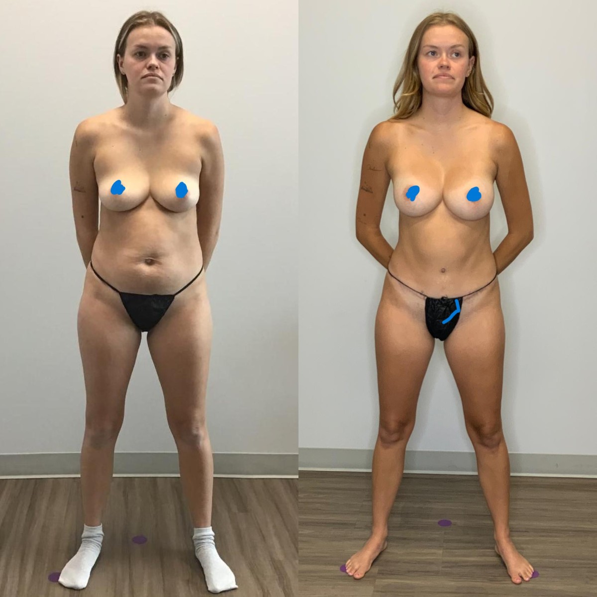 Breast Augmentation & Abdominoplasty