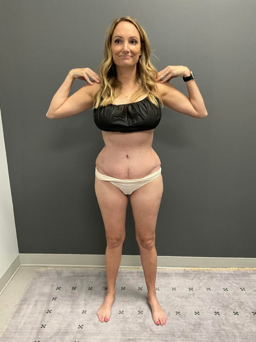 Abdominoplasty after