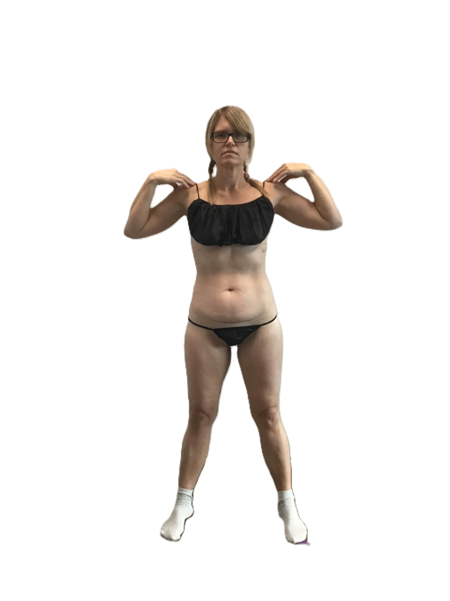 Mini Abdominoplasty before