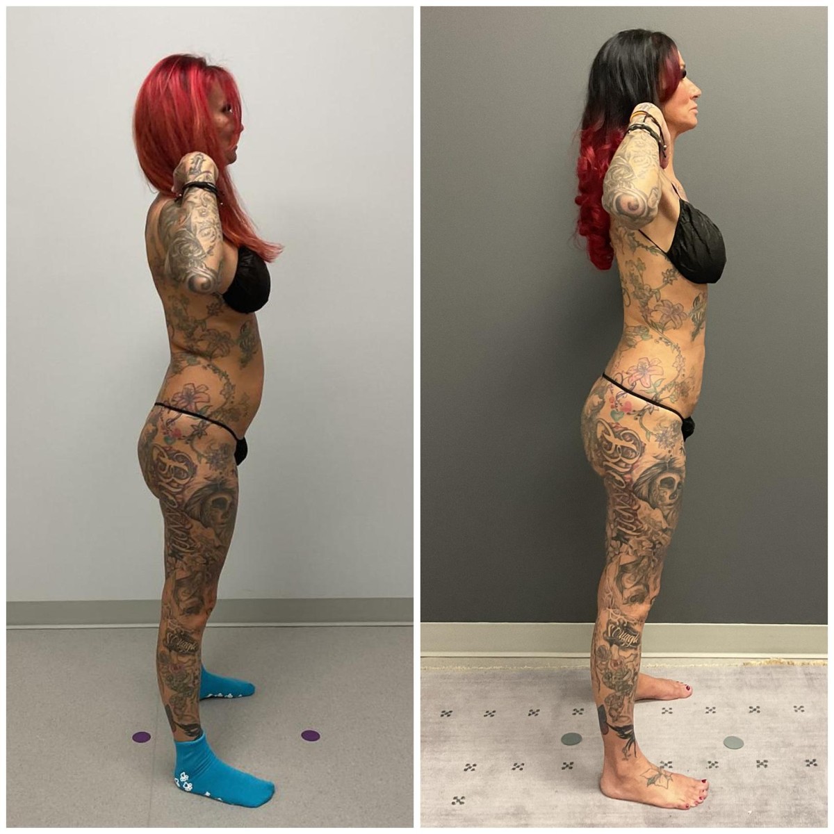 Lipo360 with BBL after