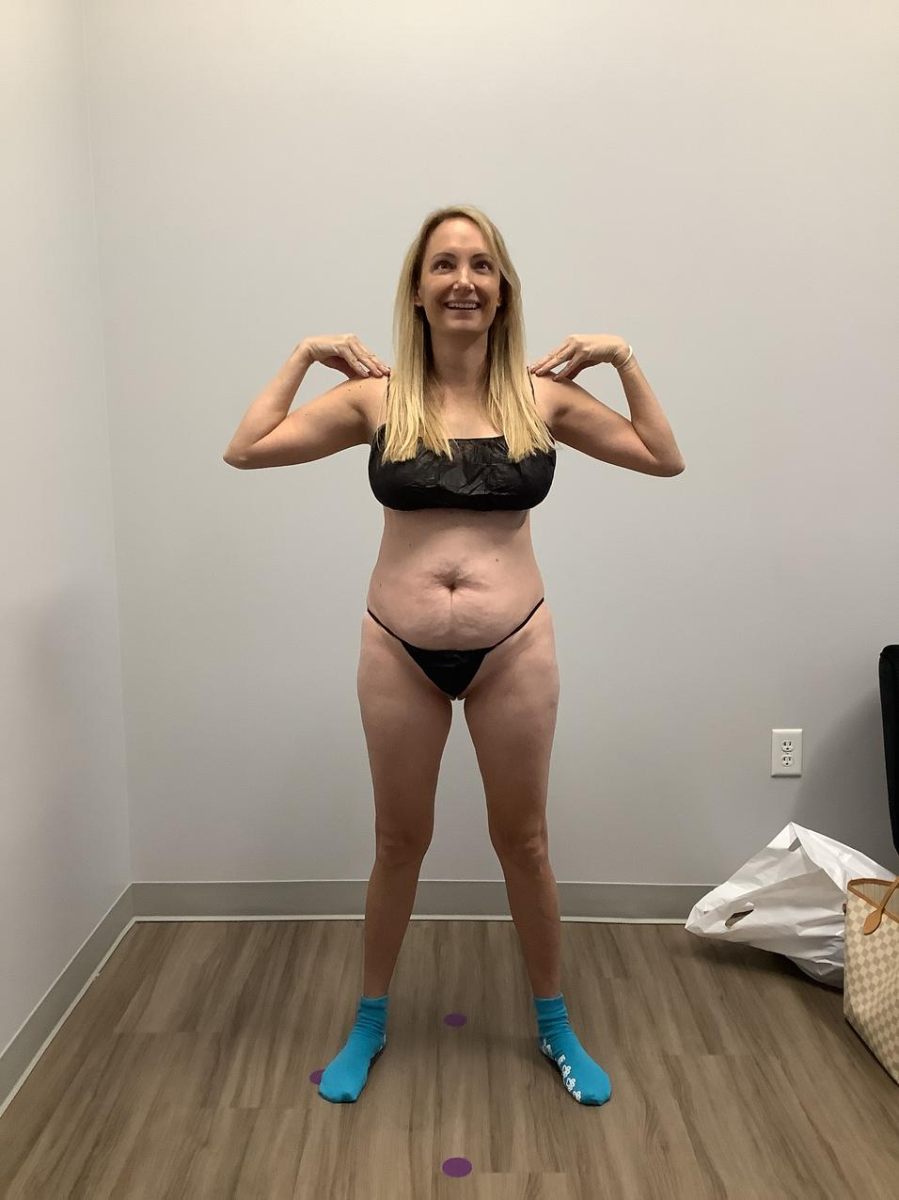 Abdominoplasty before