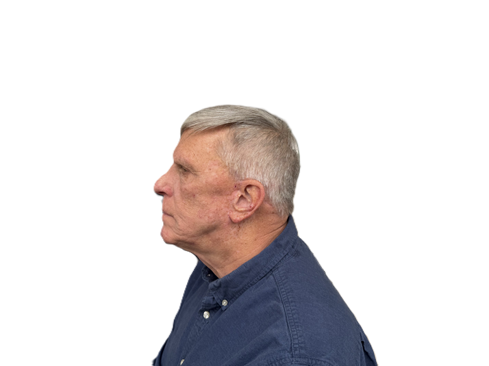 Lower Face & Neck Lift after
