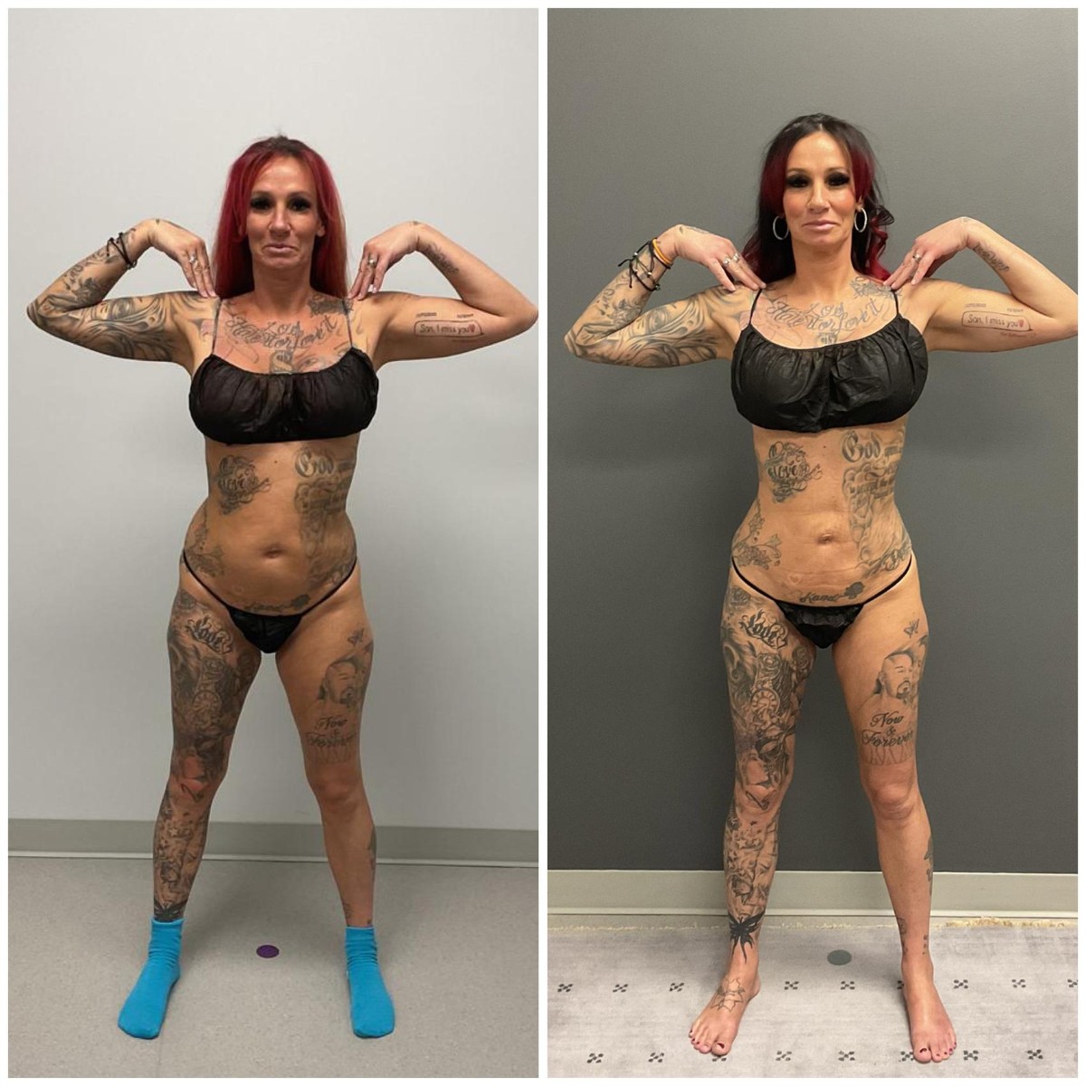 Lipo360 with BBL before