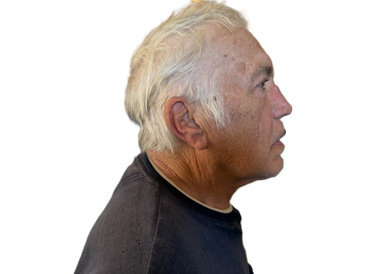 Direct Neck Lift after
