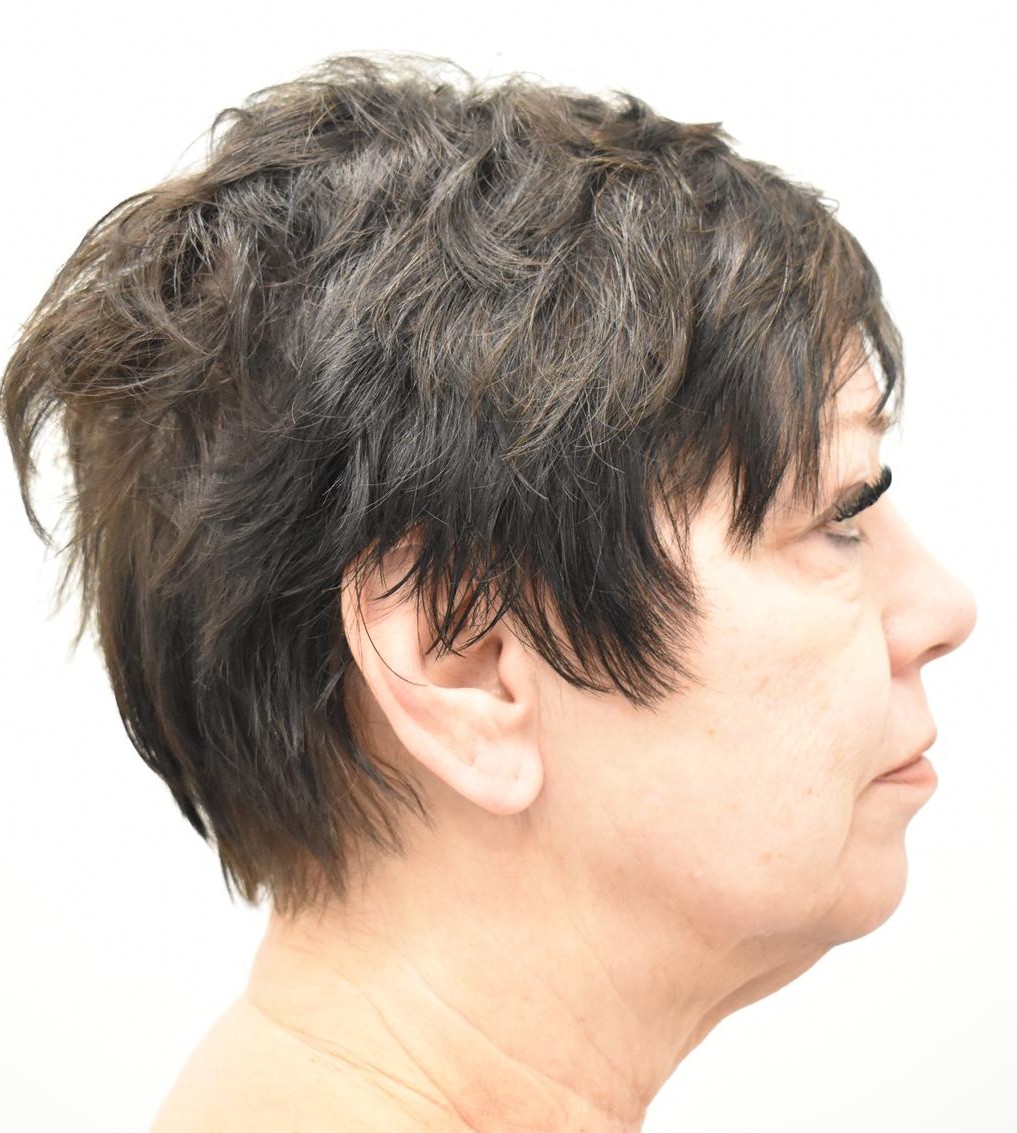 Lower Face & Neck Lift before