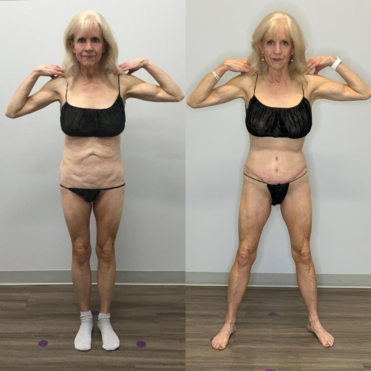 Abdominoplasty