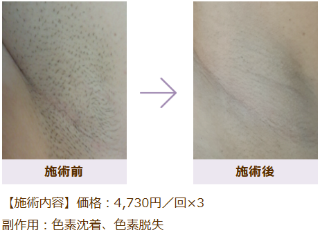 ワキ脱毛の症例写真 施術前後の比較