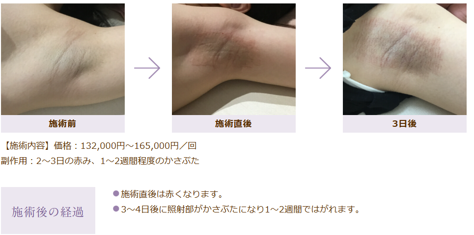 インフィニスェットの施術例