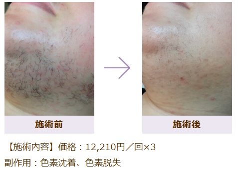 ひげ脱毛の症例写真 施術前後の比較