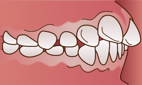 上顎前突(じょうがくぜんとつ)