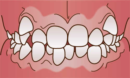 叢生(そうせい)