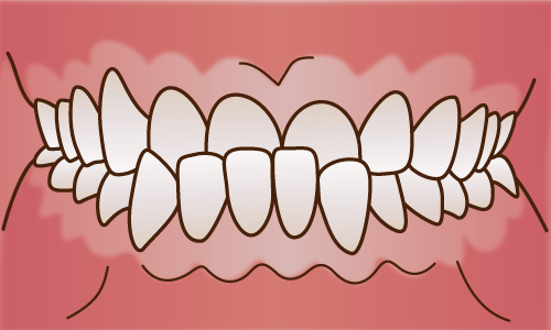 下顎前突(かがくぜんとつ)