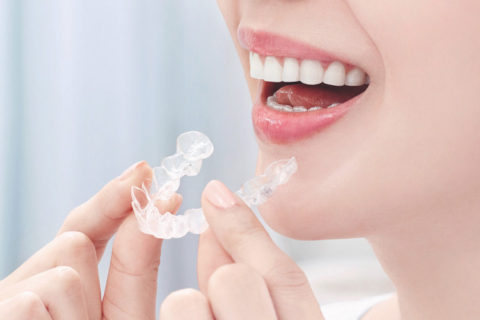 インビザライン装着イメージ1