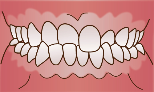 交叉咬合(こうさこうごう)