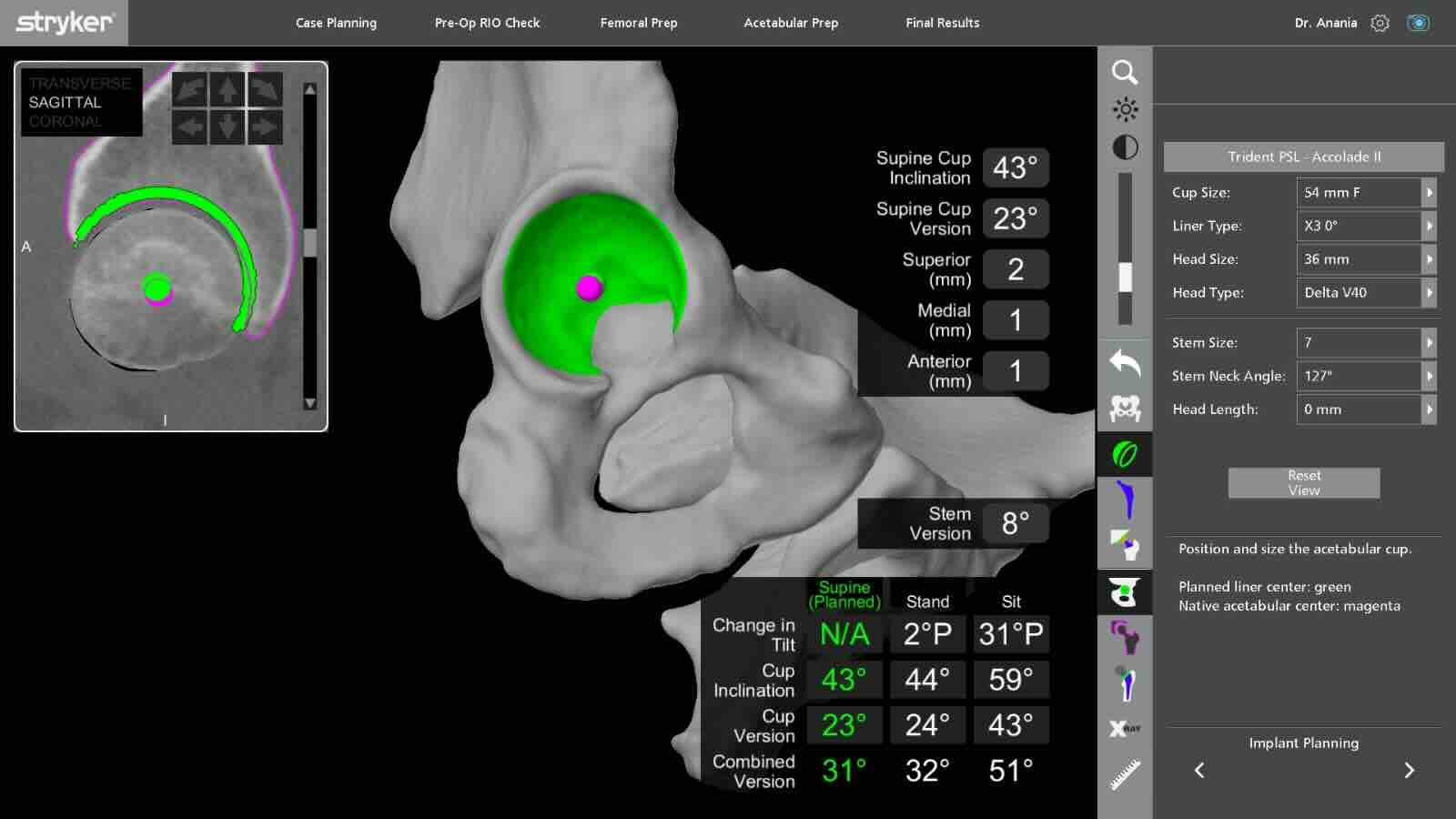 Planificación 3D pre-operatoria en sistema MAKO mostrando modelo tomográfico personalizado de articulación para cirugía robótica