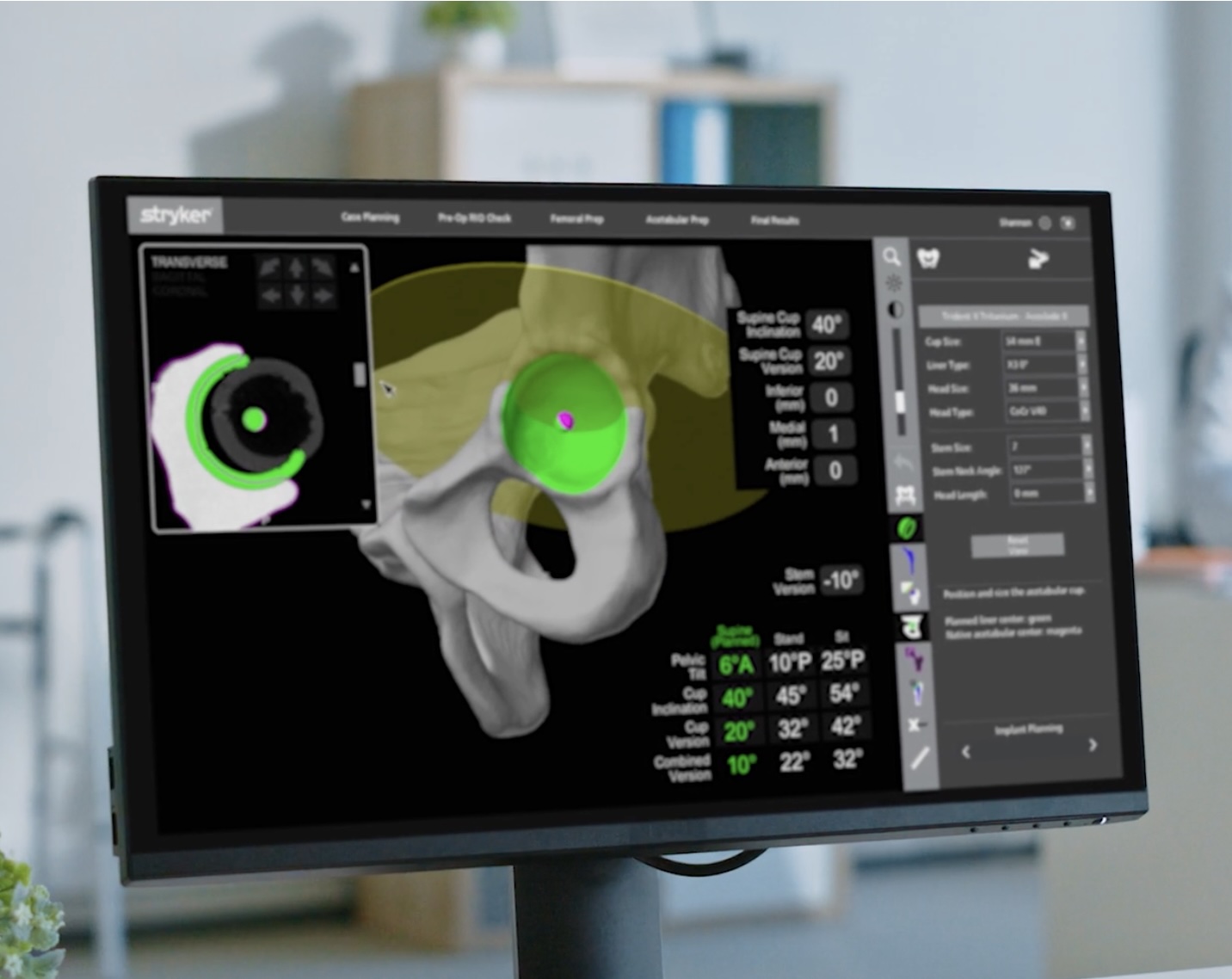 Planificación 3D Personalizada en Cirugía de Cadera