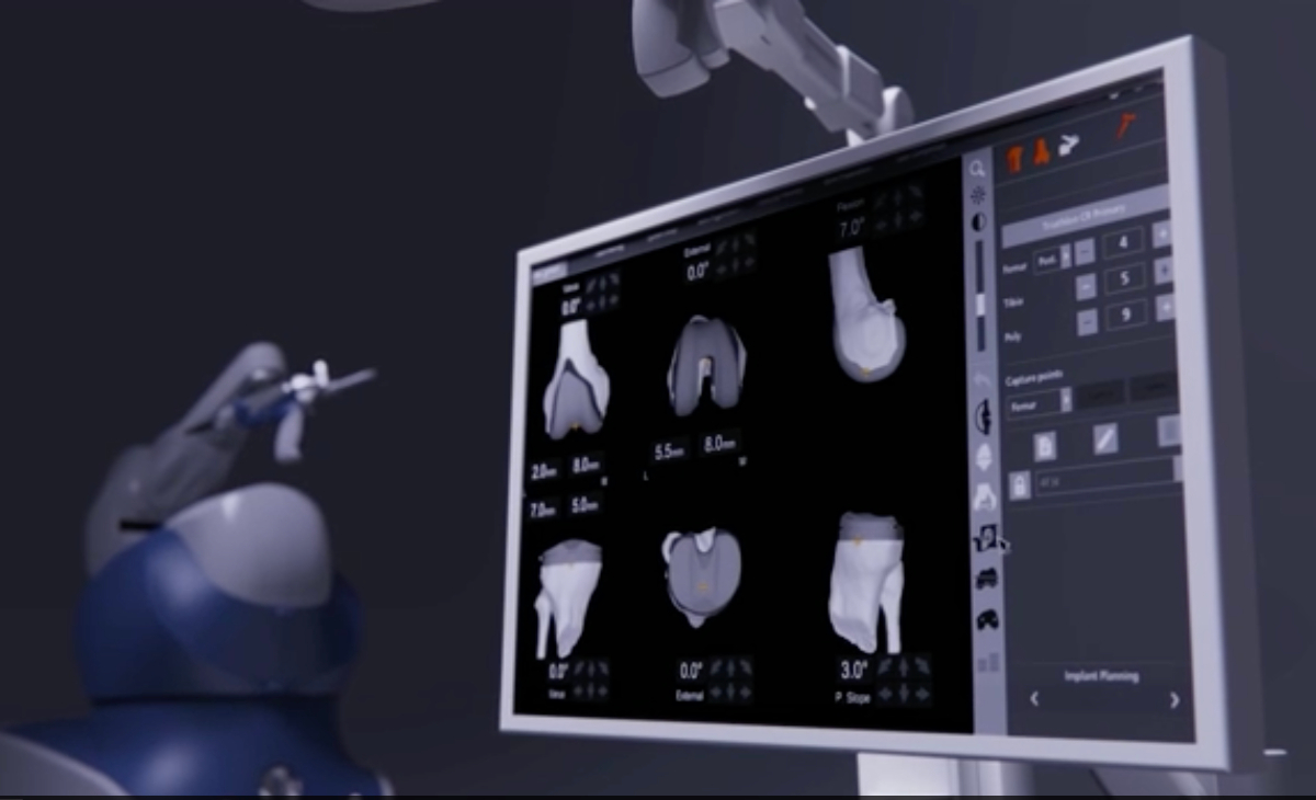 Cirugía robótica de rodilla con Mako SmartRobotics para tratamiento de artrosis y reemplazo articular