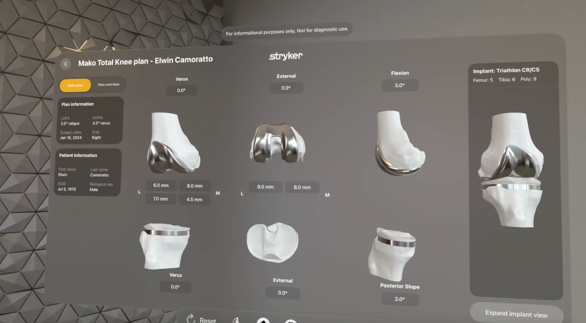 Planificación 3D personalizada con Mako SmartRobotics para cirugía robótica de cadera y rodilla artrosis