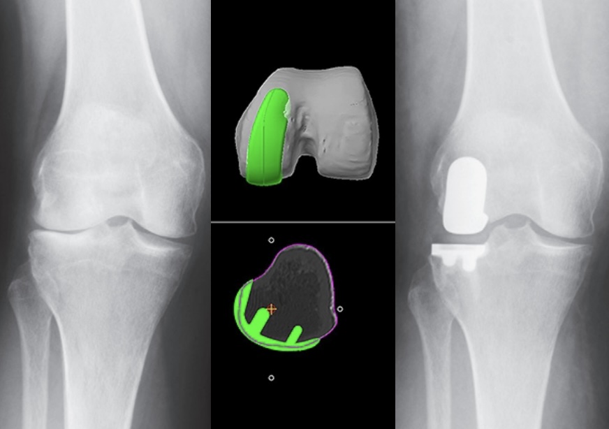 Reemplazo parcial unicompartimental de rodilla con MAKO - Preservación de tejido sano y ligamentos cruzados