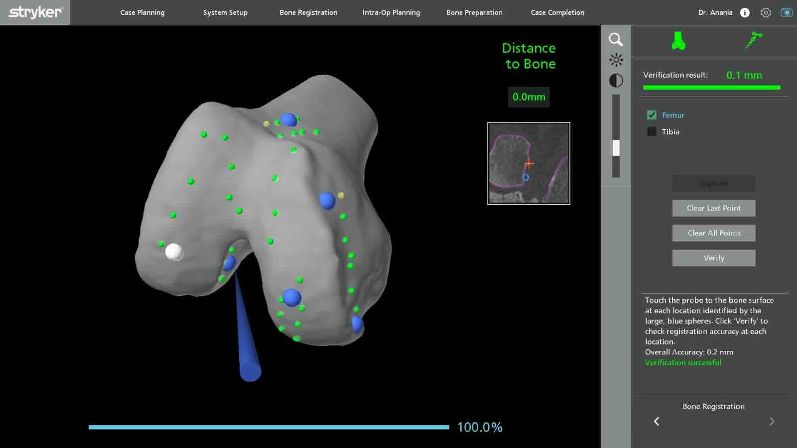 Registro y validación anatómica durante cirugía robótica MAKO - Sistema verificando puntos anatómicos contra modelo 3D
