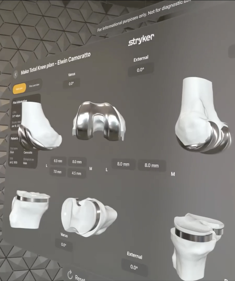 Planificación 3D personalizada pre-operatoria para cirugía robótica de rodilla MAKO - Modelo tomográfico de articulación