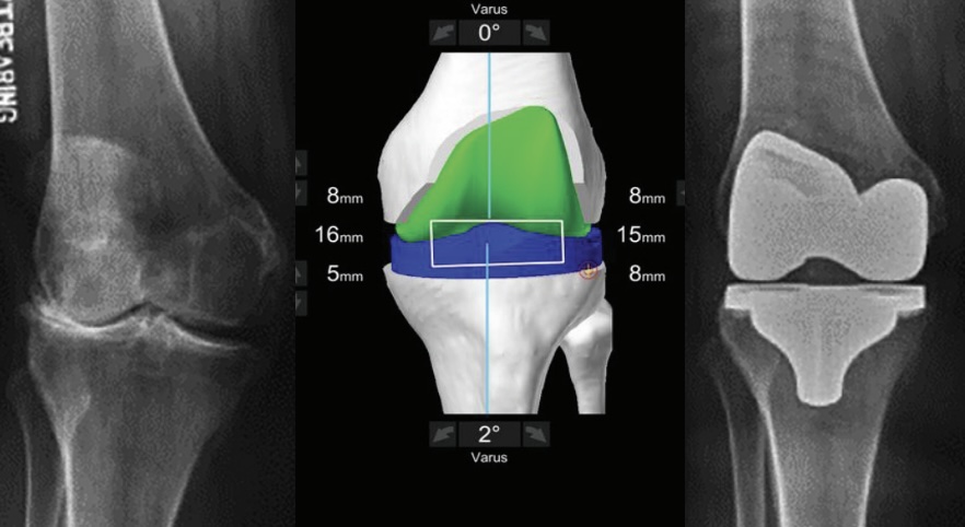 Balance Ligamentario en Reemplazo de Rodilla