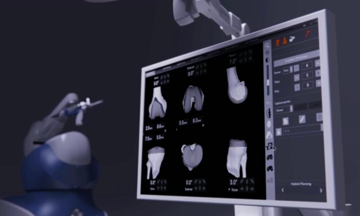 Ilustración médica anatomía de rodilla con overlay de planificación robótica MAKO SmartRobotics mostrando balance ligamentario perfecto
