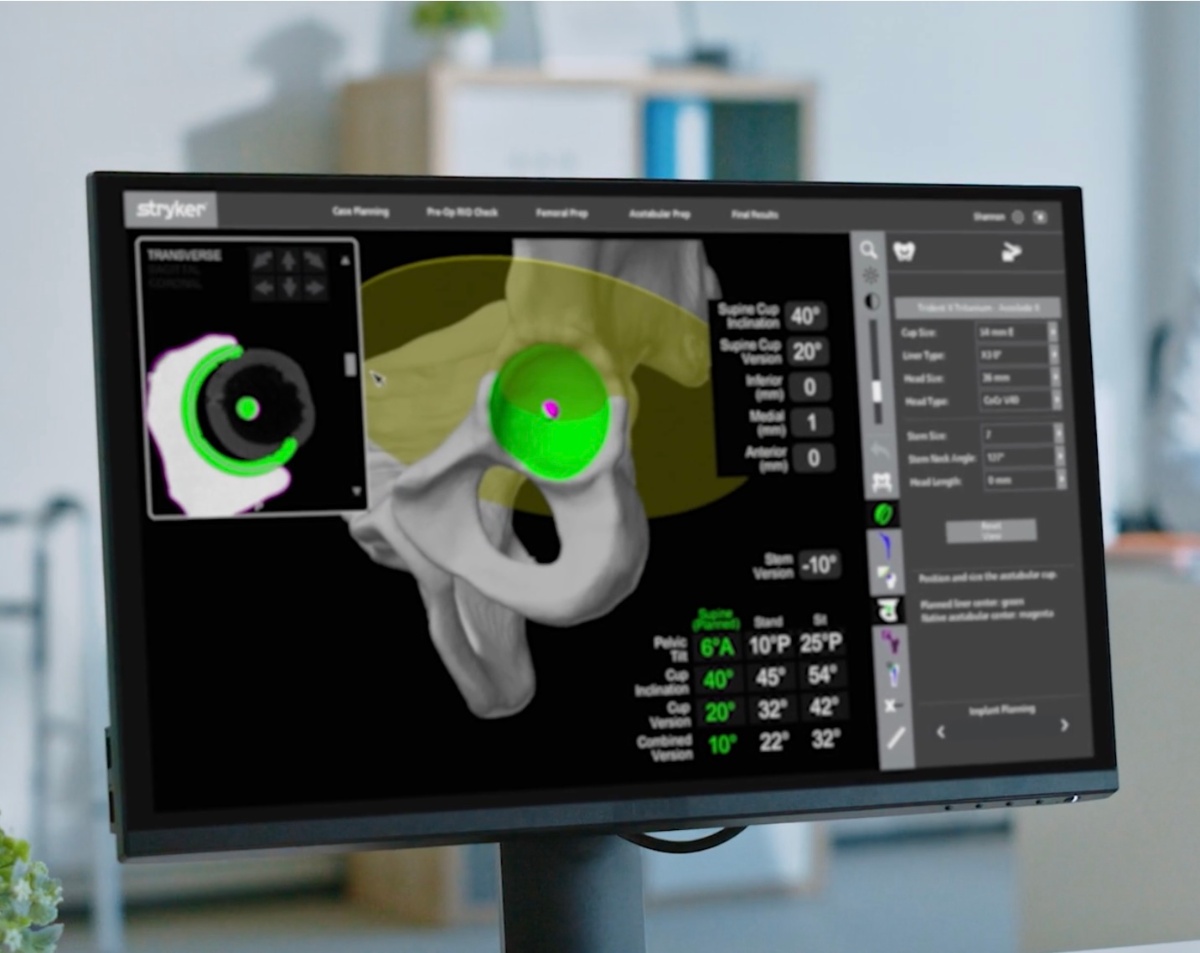 Planificación 3D personalizada pre-operatoria para cirugía robótica de cadera MAKO - Modelo tomográfico mostrando offset femoral y anteversión acetabular