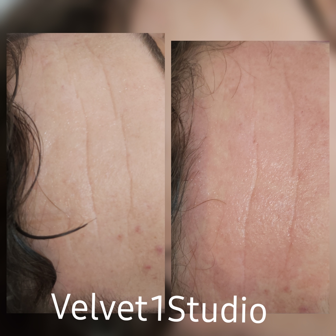 Rezultat procedură 5