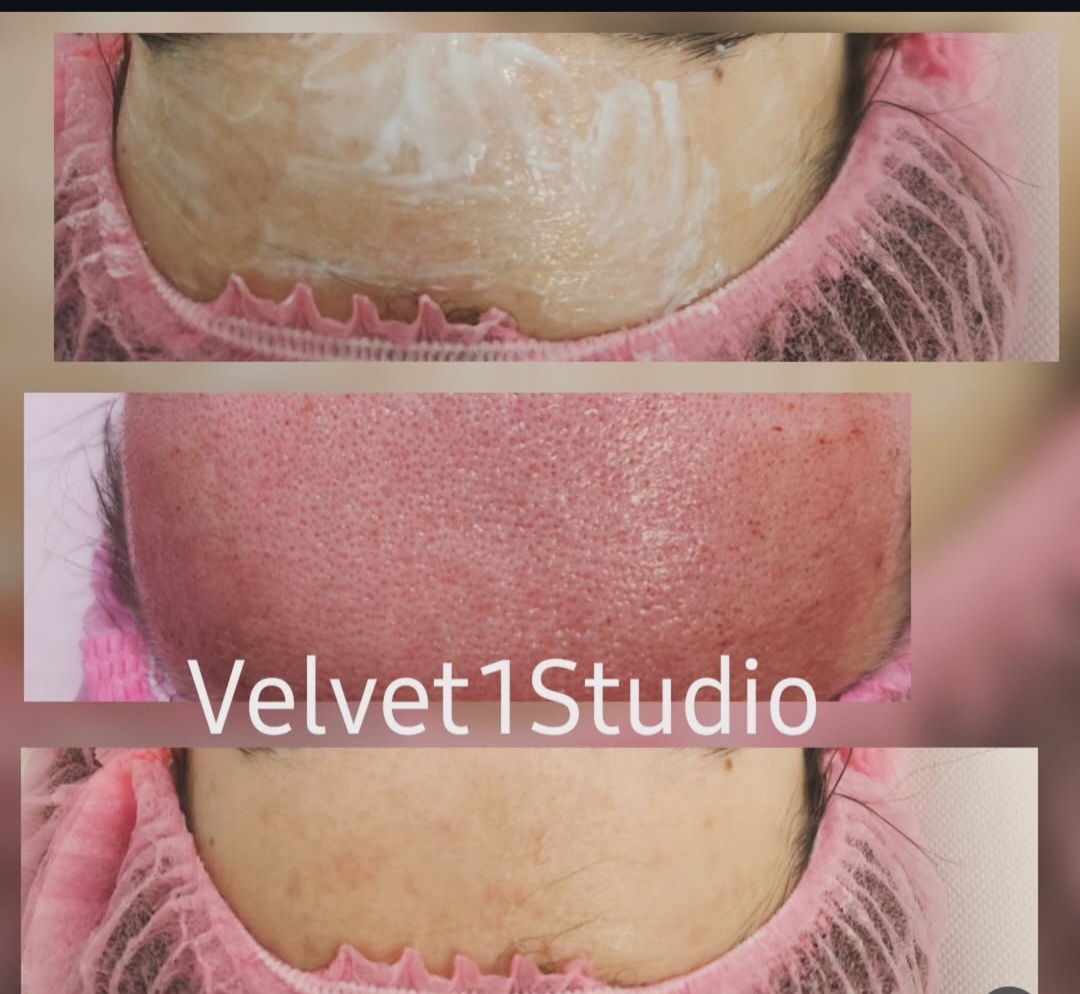 Rezultat procedură 9