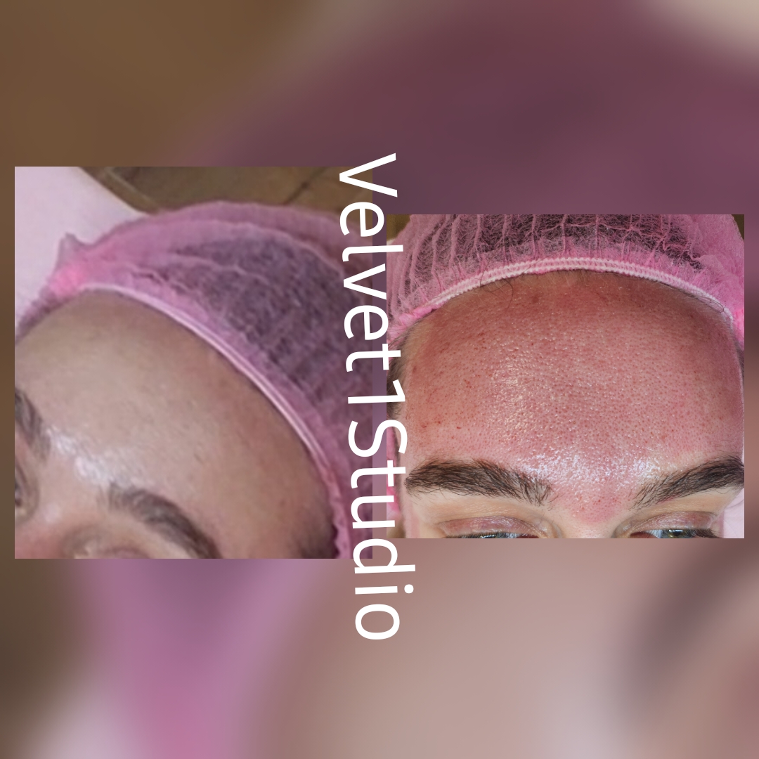 Rezultat procedură 3