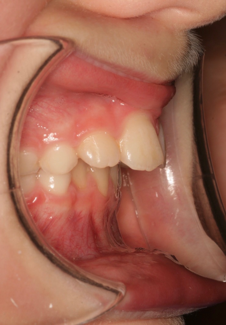 Airway facial development