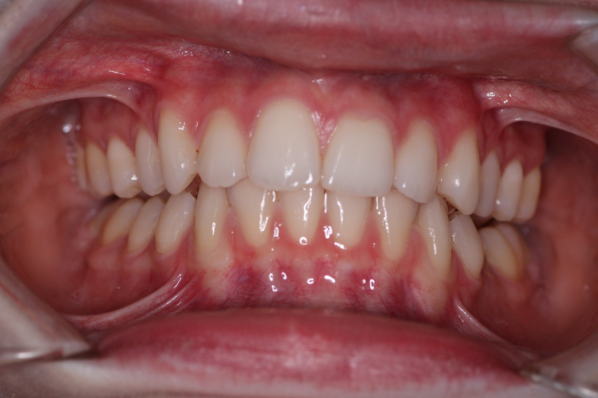Airway improvement evidence