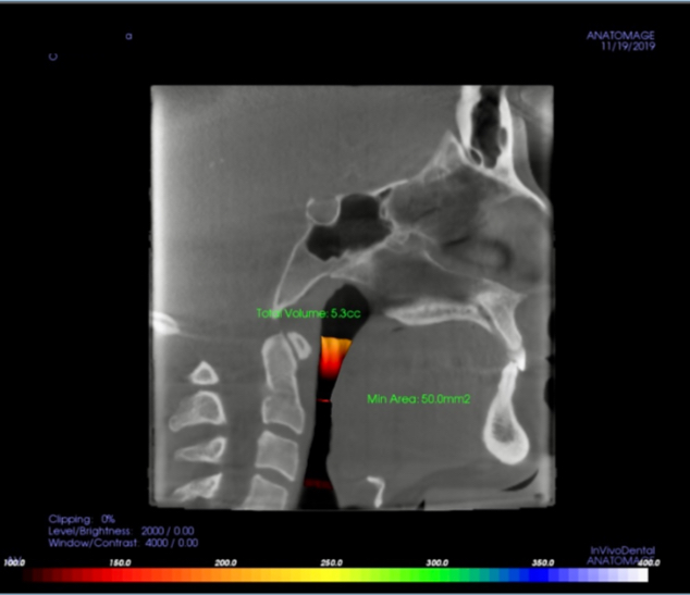 Airway Color Chart - Red Yellow Green