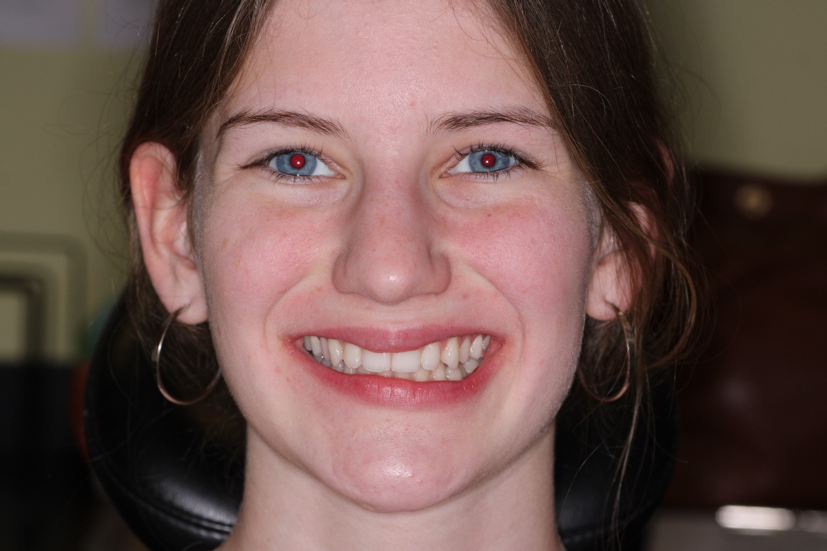 Continued facial development tracking