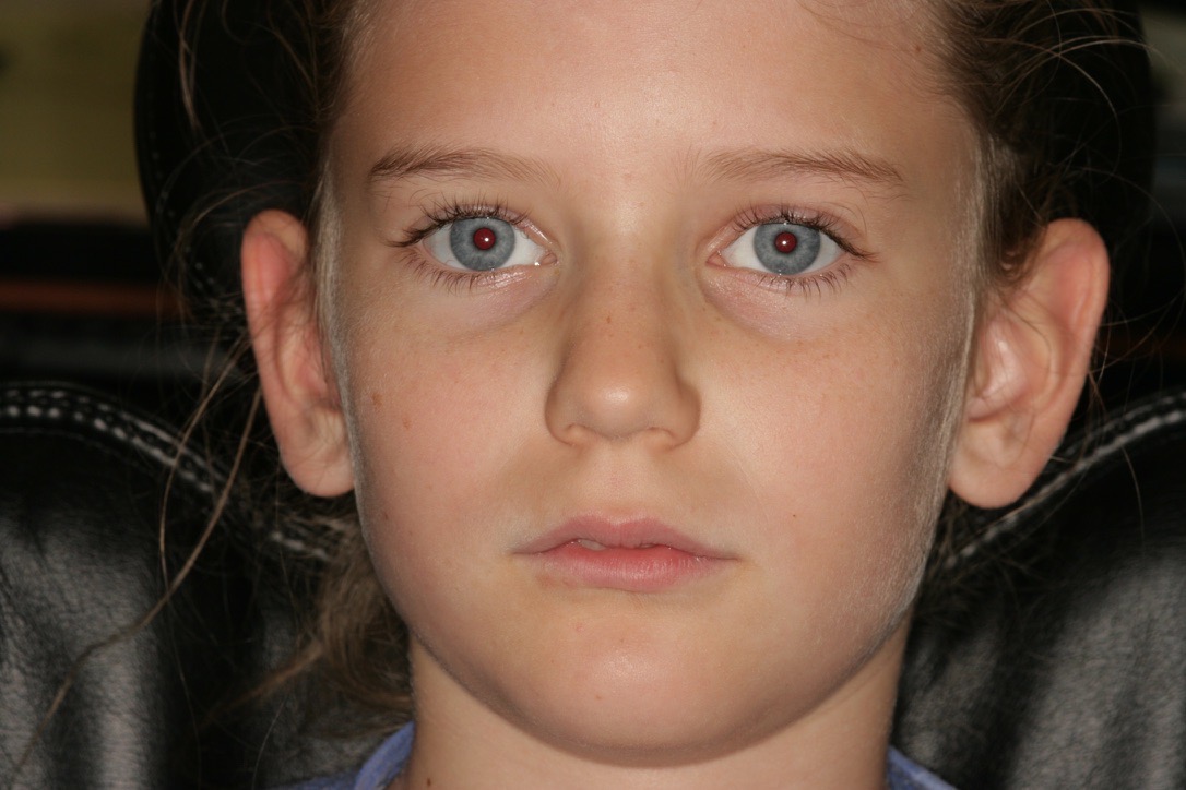 Natural growth without braces