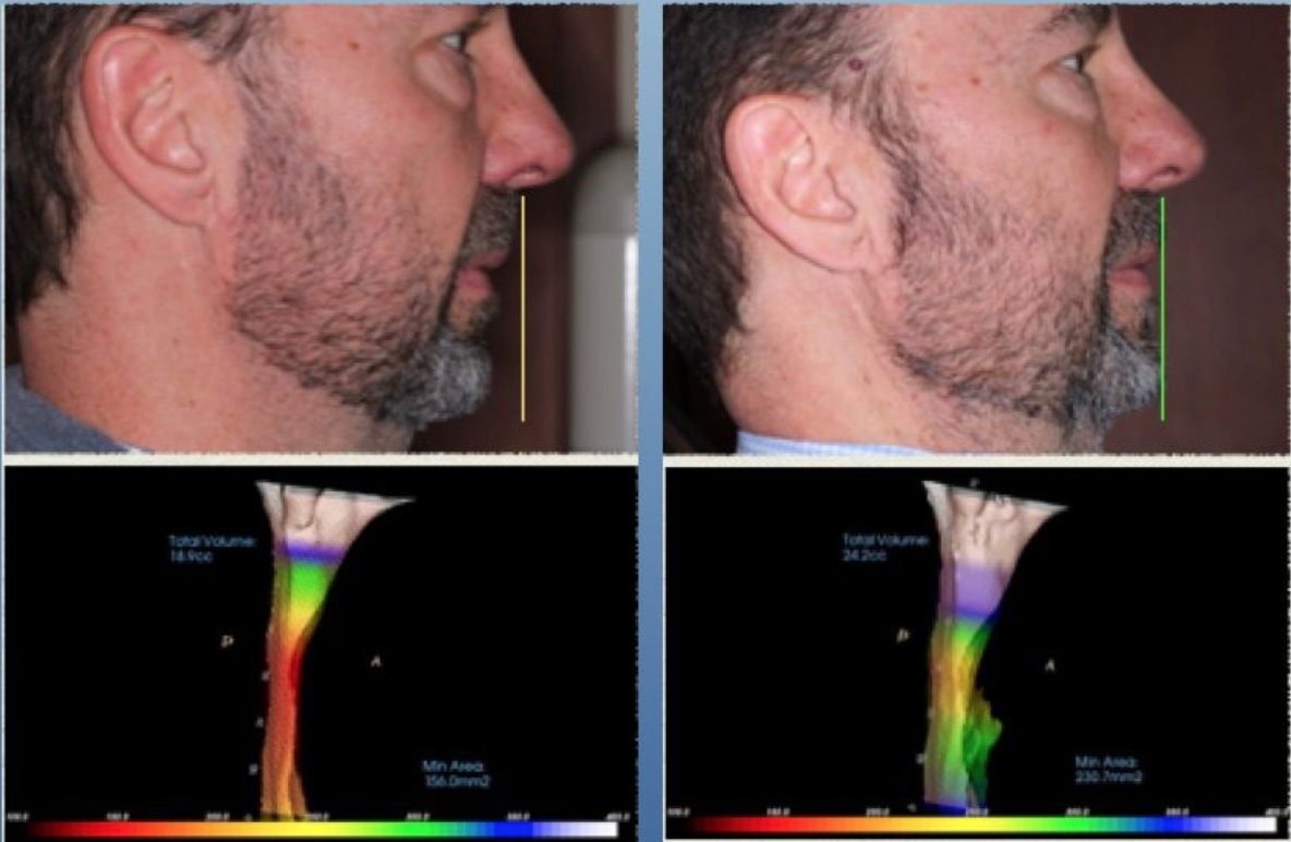 47% Wider Airway In 3 Months