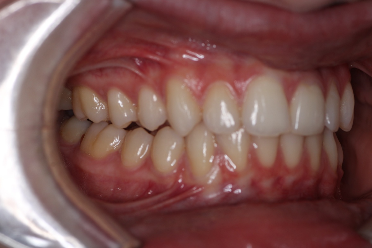 Final epigenetics outcome