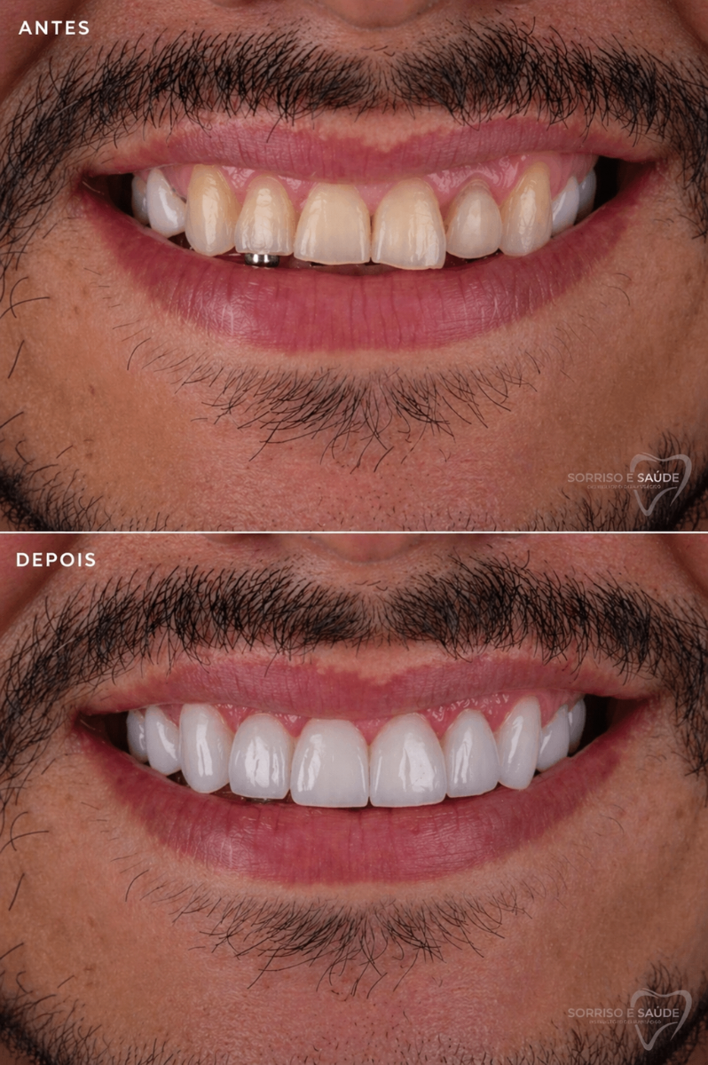 Antes e depois - Sorriso e Saúde
