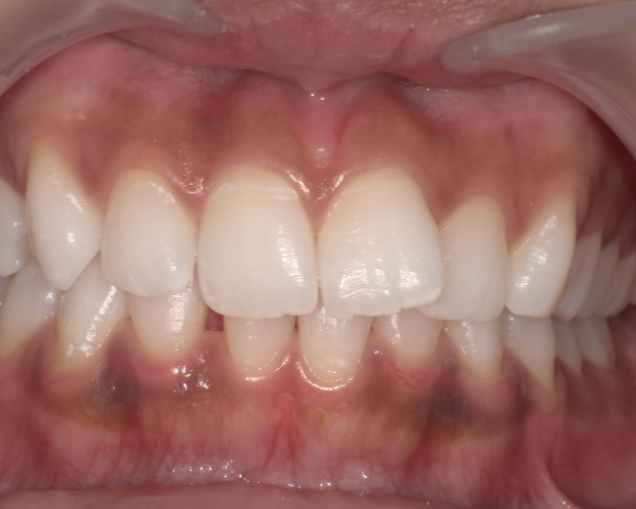 症例1 アフター