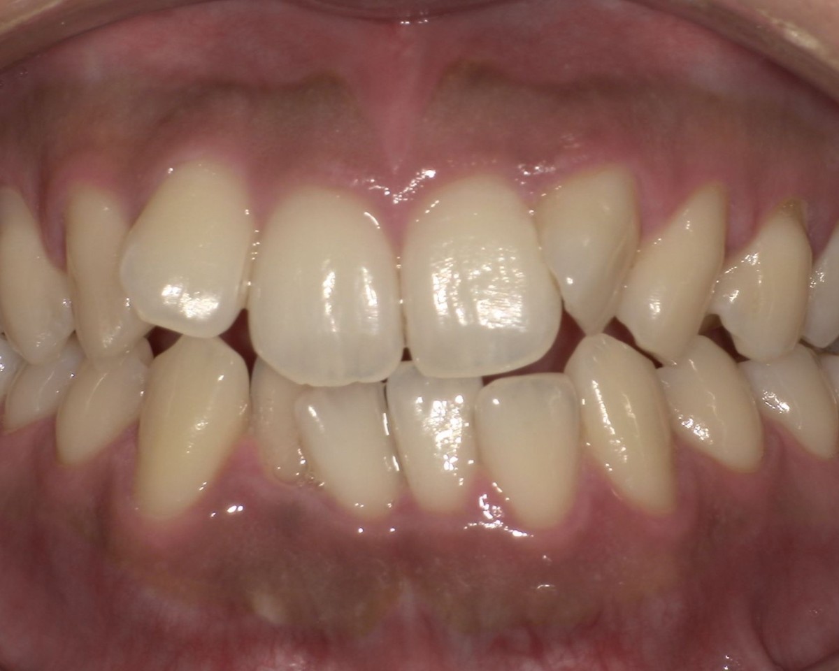 症例3:重度の捻転・叢生(ねじれ・ガタガタ) Before